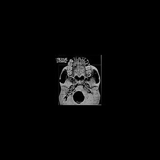 INTESTINAL DISGORGE - Everlasting Fractal Nightmare