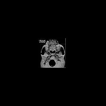 INTESTINAL DISGORGE - Everlasting Fractal Nightmare